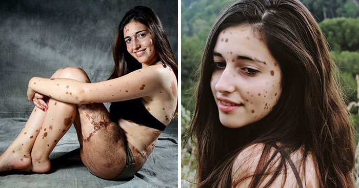 สาววัย 16 เคยถูกล้อเพราะปานกว่า 500 จุดทั่วร่างกาย ทว่าตอนนี้เธอเป็นนางแบบไปแล้ว…
