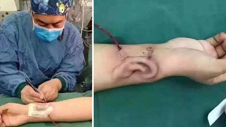 สะเทือนวงการแพทย์!! หมอชาวจีนประสบความสำเร็จ ในการปลูกถ่ายหูเทียมไว้ที่แขนผู้ป่วย