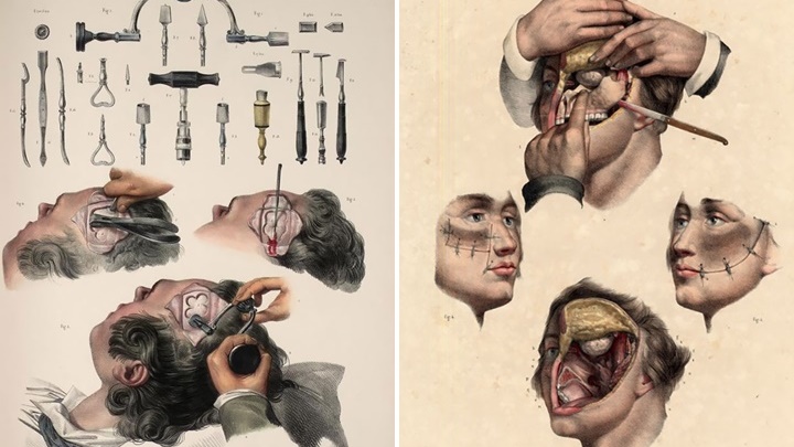 รูปภาพชวนสะพรึงของตำราแพทย์ ว่าด้วยการผ่าตัดในยุค 1830 น่ากลัวแต่ก็เปี่ยมด้วยความรู้