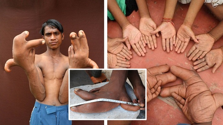 เด็กหนุ่มวัย 12 ปี ถูกกีดกันจากสังคม เพราะนิ้วมือขนาดยักษ์ที่ยาวถึง 30 เซนติเมตร!!