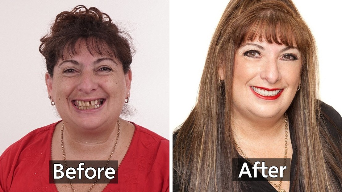 คุณป้าที่ไม่ยอมพบหมอฟันมานาน 15 ปี ได้พบชีวิตใหม่หลังจากยอมเข้ารับการรักษา