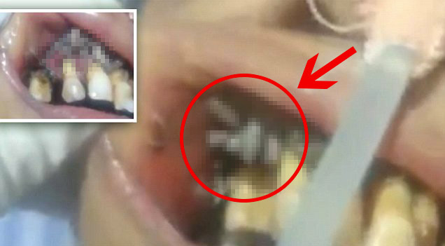 เจอแบบนี้มีผวา… วินาทีหมอตรวจฟันคนไข้สาว เปิดปากเจอฟันเหลือง-หนอนแมลงไชเต็มปาก!!!