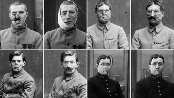 สงครามเปลี่ยนคน.. ภาพก่อน-หลังศัลยกรรมใบหน้า ของเหล่าทหารกล้าที่บาดเจ็บใน WW1