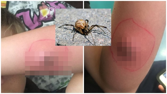 ร้ายแรง เด็กหนุ่มโชคร้ายถูกแมงมุมแม่ม่ายกัด และนั่นได้ฝากแผลเป็นเอาไว้บนร่างกายเขา