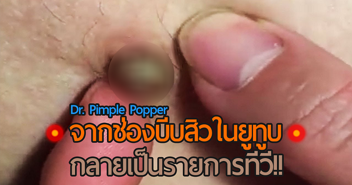 จากช่องยูทูบโชว์การบีบสิวแบบฟินๆ Dr. Pimple Popper ตอนนี้ได้เป็นรายการออกทีวีแล้ว!!