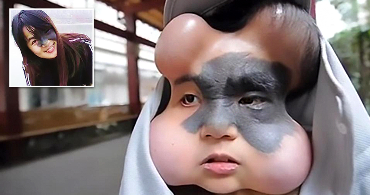 สาวจีนผู้เกิดมาพร้อมปานบนหน้าขนาดใหญ่ ต้องฝังลูกโป่งลงบนใบหน้าเพื่อหลีกเลี่ยงมะเร็งร้าย
