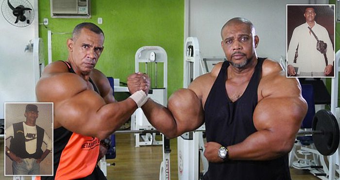 สองพี่น้องชาวบราซิล ฉีดสารเคมีอันตรายเข้าไปในร่างกาย จนมีแขนขนาดใหญ่กว่า 25 นิ้ว!!
