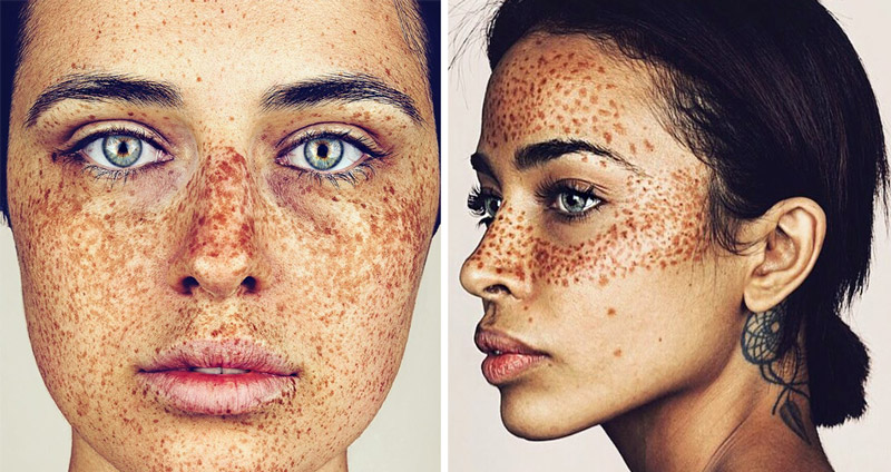 ช่างภาพสร้างสรรค์โปรเจกต์ Freckles แสดงให้เห็นถึงความงดงามของ ‘ร่องรอย’ ที่เกิดขึ้นบนผิวหนัง