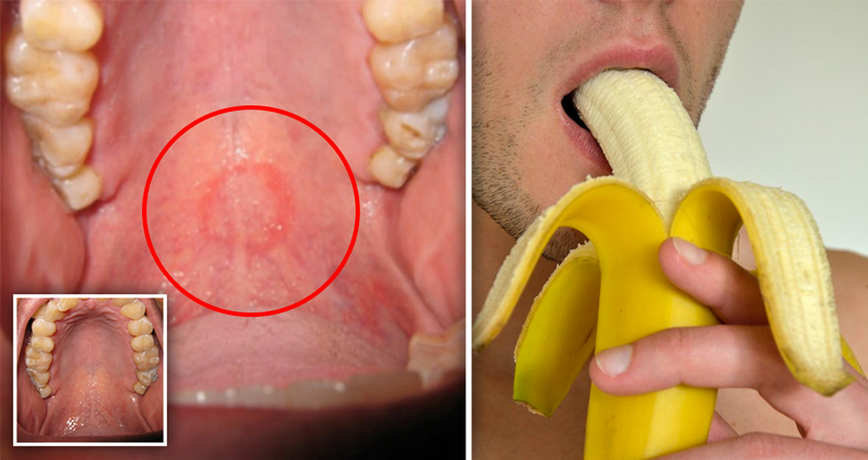 แพทย์ชี้ รอยแดงปริศนาบนเพดานปาก ของชายวัย 47 ปี เกิดจากการ “อมนกเขา” มากจนเกินไป?!