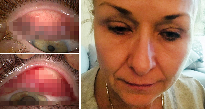 มาสคาร่าทำพิษ… หญิงเผยสภาพเปลือกตาตัวเอง ตลอด 25 ปี ไม่ล้างให้สะอาดก่อนเข้านอน