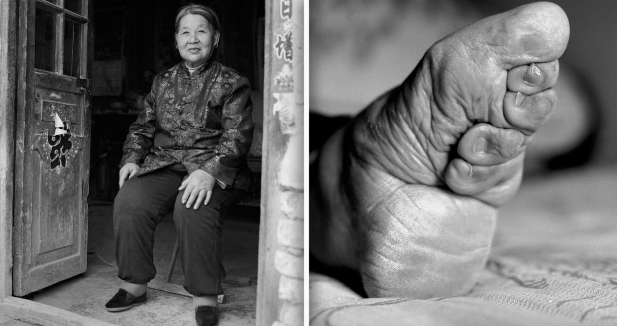 15 ภาพของผู้ที่มี “เท้าดอกบัว” กลุ่มสุดท้ายบนโลก อดีตความงามที่แลกมาด้วยความเจ็บปวด
