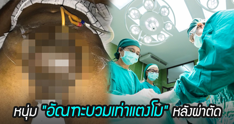 อุบัติเหตุจากการผ่าตัด ทำให้ “ถุงอัณฑะ” ของคนไข้หนุ่ม บวมใหญ่เท่ากับ “ลูกแตงโม”!!