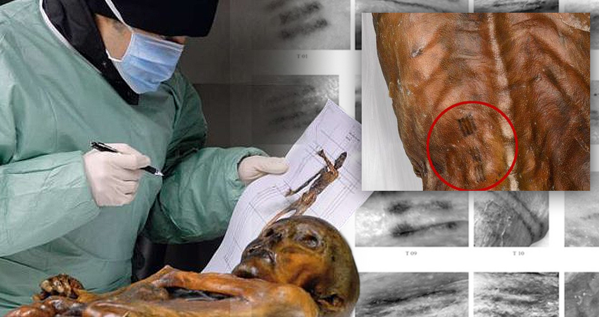 นักวิทย์กล่าว รอยสักมัมมี่โบราณ 5,300 ปี แท้จริงแล้วอาจเป็นการ “ฝังเข็ม” เพื่อรักษา