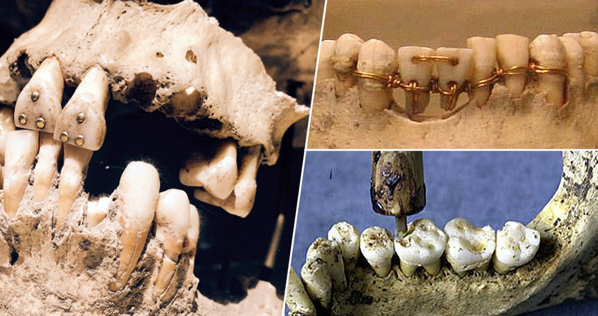 เปิดประวัติ “ทันตกรรม” ศาสตร์ที่ยืนยงคู่กับมนุษย์ และอยู่มานานกว่า 9,000 ปี
