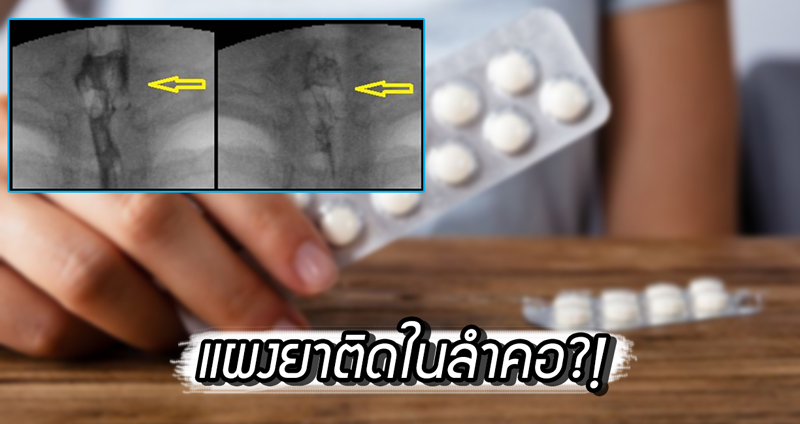 หมอสงสัยพบ ‘แผงยา’ ติดอยู่ในลำคอผู้หญิงกว่า 17 วัน เธอจะกินเข้าไปทำไมเล๊า!!