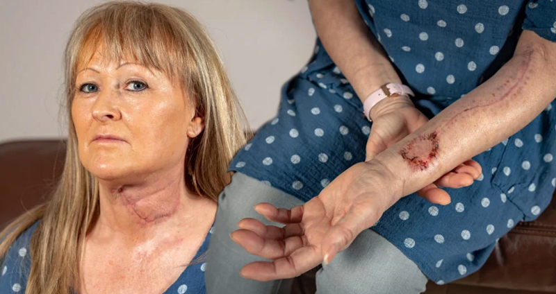 หญิงผู้ป่วยมะเร็ง ต้องเสียลิ้นไป แต่ได้รับลิ้นใหม่ จากการปลูกถ่ายโดยใช้ “ผิวหนังจากแขนซ้าย”