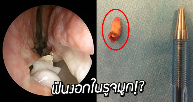 ชายสูงวัยถูกพบ ‘มีฟันงอกในจมูก’ แพทย์บอกเป็นอาการที่หาได้ยากและเกิดขึ้นน้อยครั้งบนโลก!?
