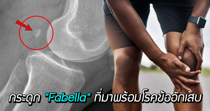 นักวิทย์พบ กระดูก “Fabella” ซึ่งค่อยๆ หายไปในอดีต กำลังกลับมาอีกครั้งพร้อมโรคข้ออักเสบ