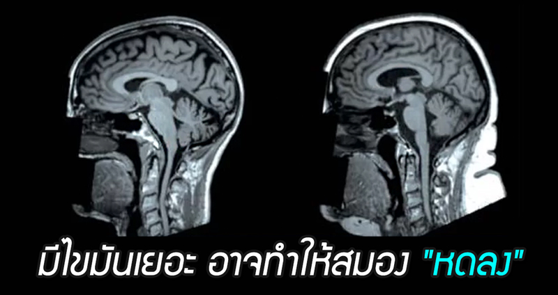 งานวิจัยใหม่เผย การมีอัตราส่วนไขมันในร่างกายสูง อาจทำให้สมองของเรา “หดลง”