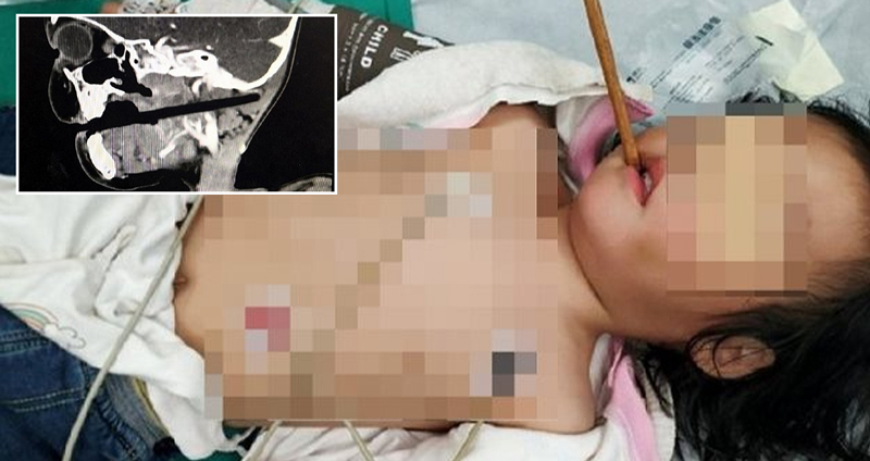 หนูน้อย 3 ขวบถือตะเกียบวิ่งเล่น สุดท้ายทำตะเกียบทะลุเข้าปาก แพทย์เร่งผ่าตัดด่วน!!