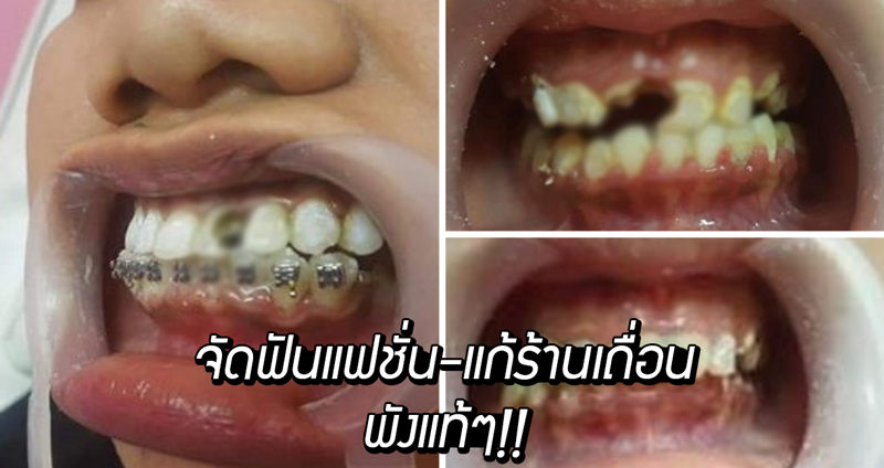 ชาวทวิตแชร์เรื่องตลกร้าย ‘จัดฟันแฟชั่น’ ทำฟันผิดรูปพังยับเยิน แก้กับร้านเถื่อนอีกต่อ!!