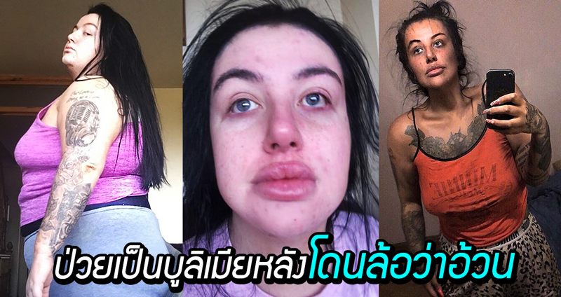 สาวป่วยเป็นโรคคิดว่าร่างกายตนเองผิดปกติ โดนคนด่าว่าอ้วน จนเป็นโรคบูลิเมียเพิ่ม