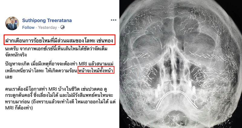 คุณหมอศัลยกรรมเตือน ‘ร้อยไหมด้วยทอง’ เมื่อเข้าทำ MRI อาจทำหน้าไหม้ได้!!